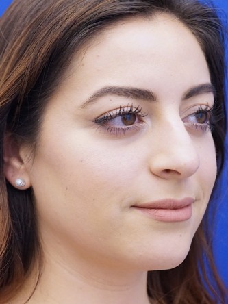 Finesse Nasal Aesthetics* — Before