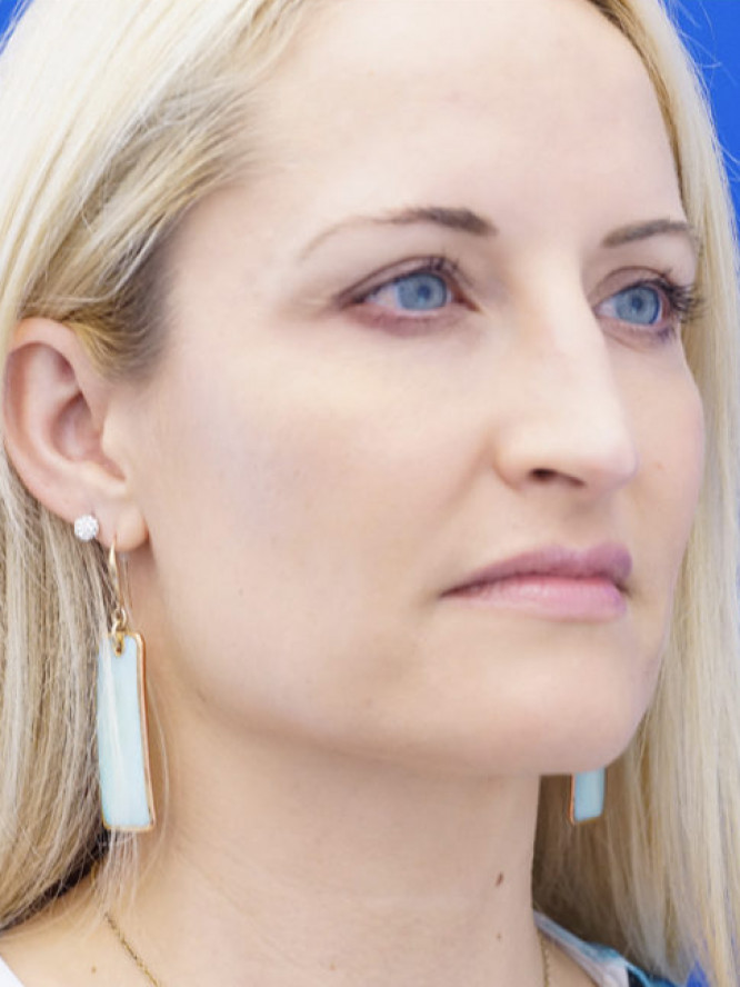 Nasal Profile Finesse — Before