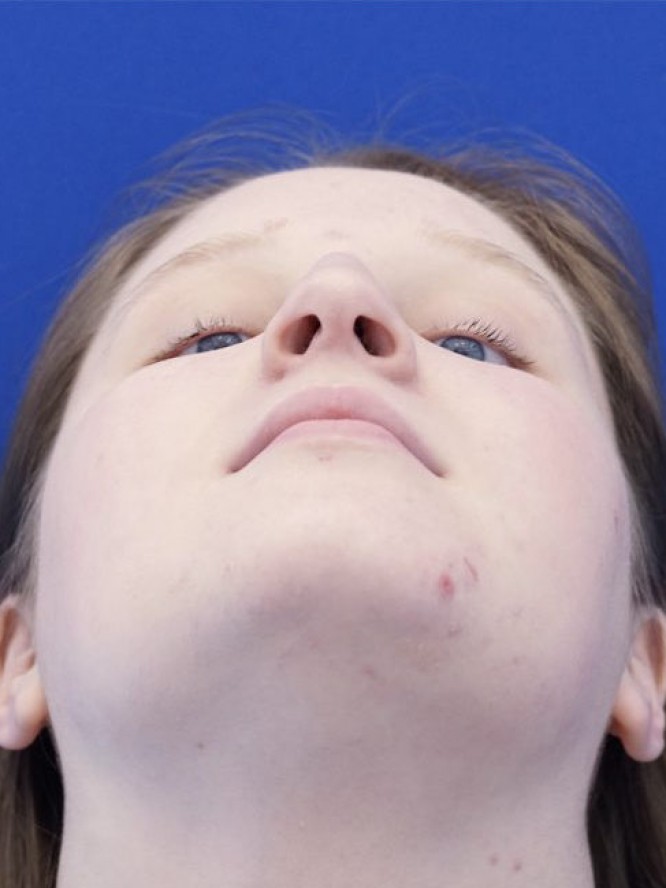 Reduction Dorsal Hump — Before