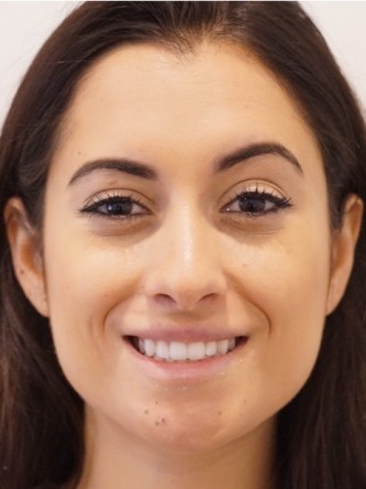 Restylane Silk to Volumize Lower Lip* — After