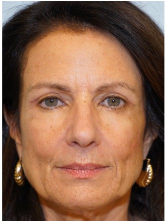 Upper Eyelid Skin Excess1* — After