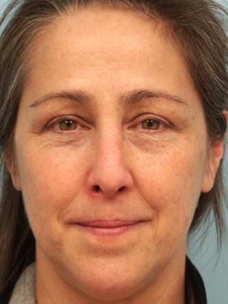 Nasal Septal Perforation2* — Before