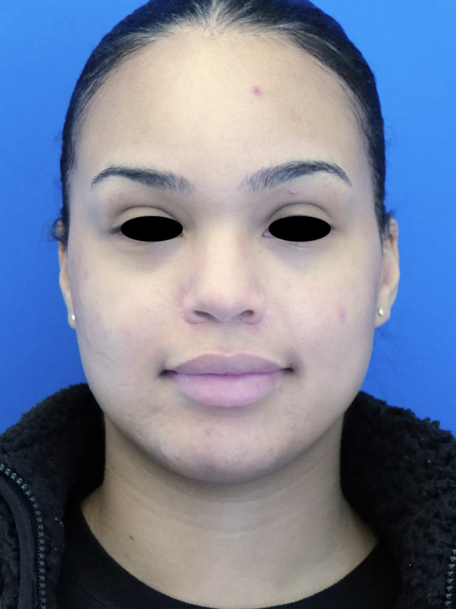 Narrow Nasal Base and Sill — After