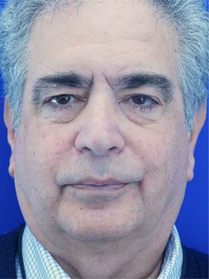 Four Quadrant Blepharoplasty — Before