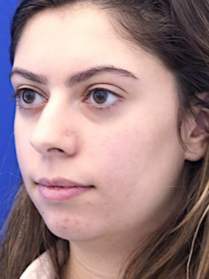 Hump Reduction and Chin Projection — Before