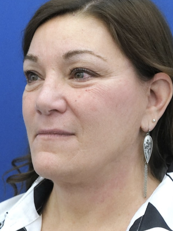 Full Upper and Lower Facelift — After