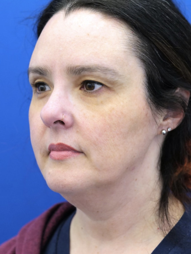 Awesome Jawline — Before