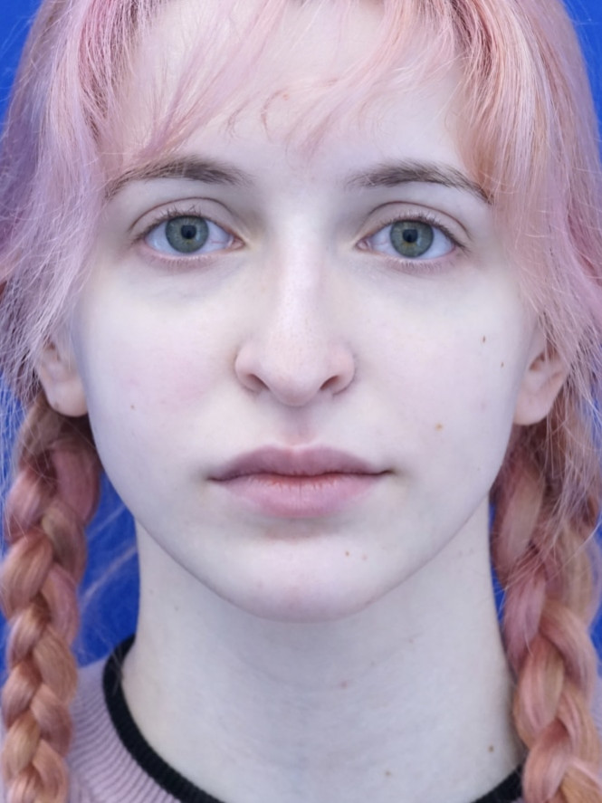 Long Droopy Tip — Before