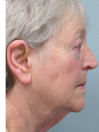 Aging Eyelid, Facelift, Necklift, Fractional CO2 Laser Resurfacing* — Before