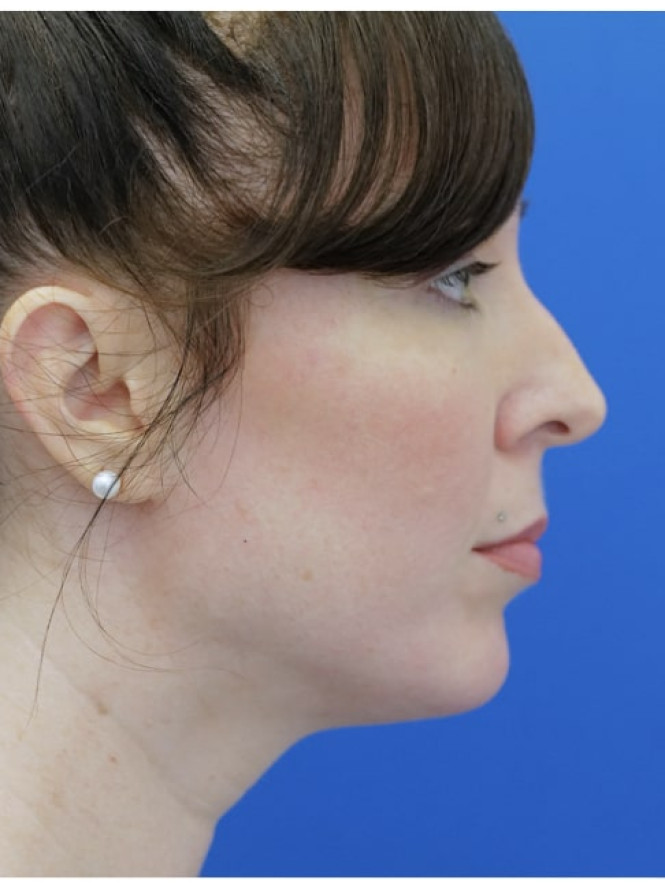 Dorsal Preservation and Refinement — Before