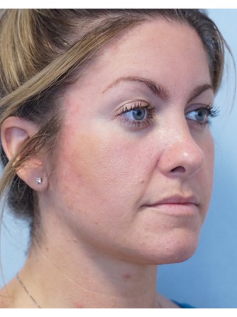 Boxy Tip Endonasal Rhinoplasty* — After