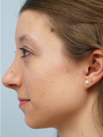 Prominent Nose Closed Rhinoplasty* — After
