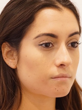 Restylane Silk to Volumize Lower Lip* — Before