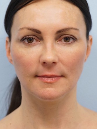 Mini Lift, Laser Resurfacing, Facial Filler* — After