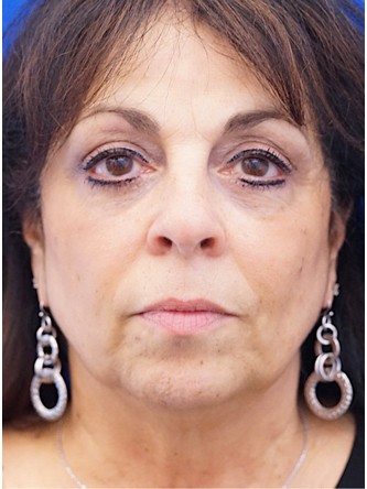 Lower Eyelid Fat Removal* — After