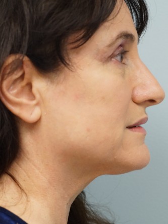 Mini Face and Neck Lift* — Before