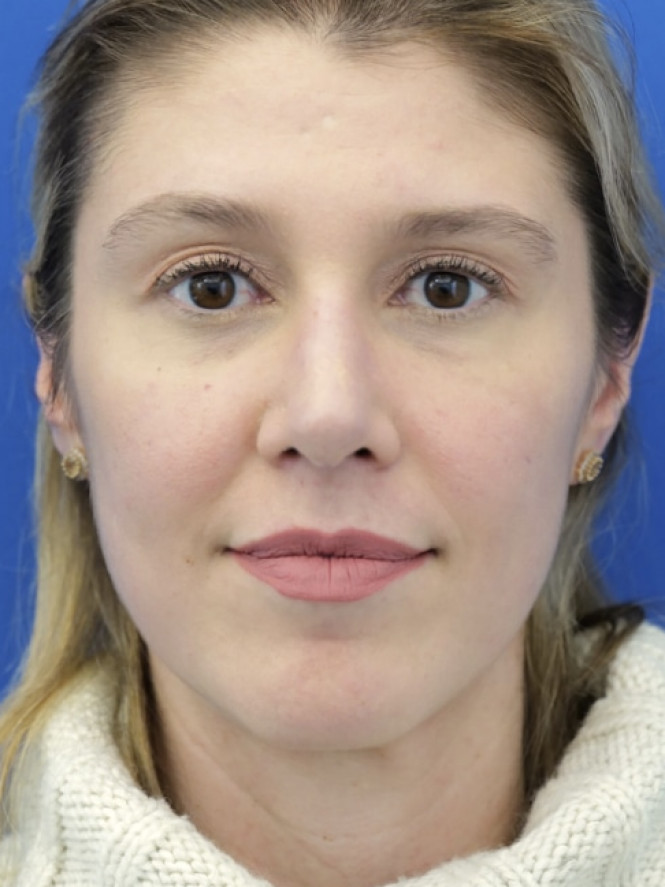 Dorsal Hump and Finesse Tip — After