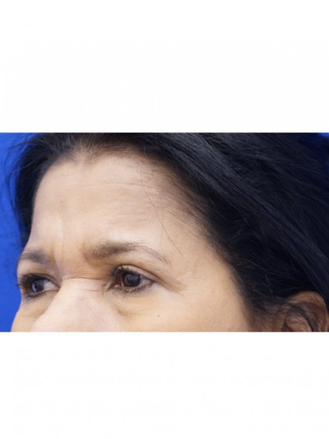 Endoscopic Forehead Lift — Before
