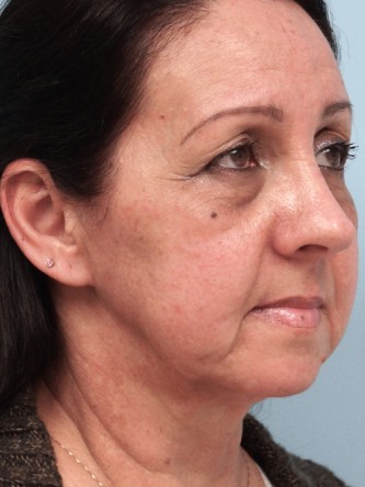 Aging Eyelid Rejuvenation, Facelift, Necklift 2* — Before