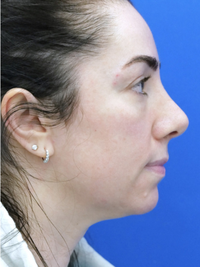 Tip Asymmetry — After
