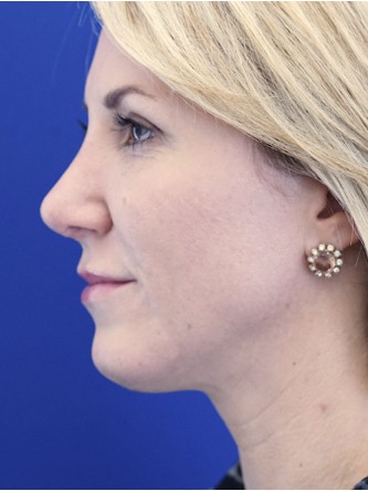 Enhance Chin Projection* — After