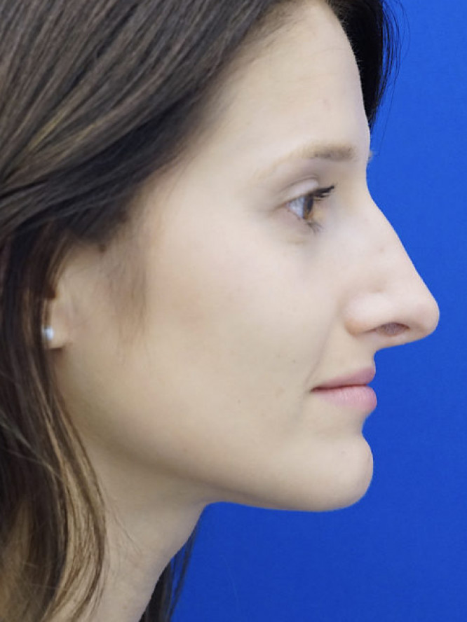 Nasal Profile Bliss — Before