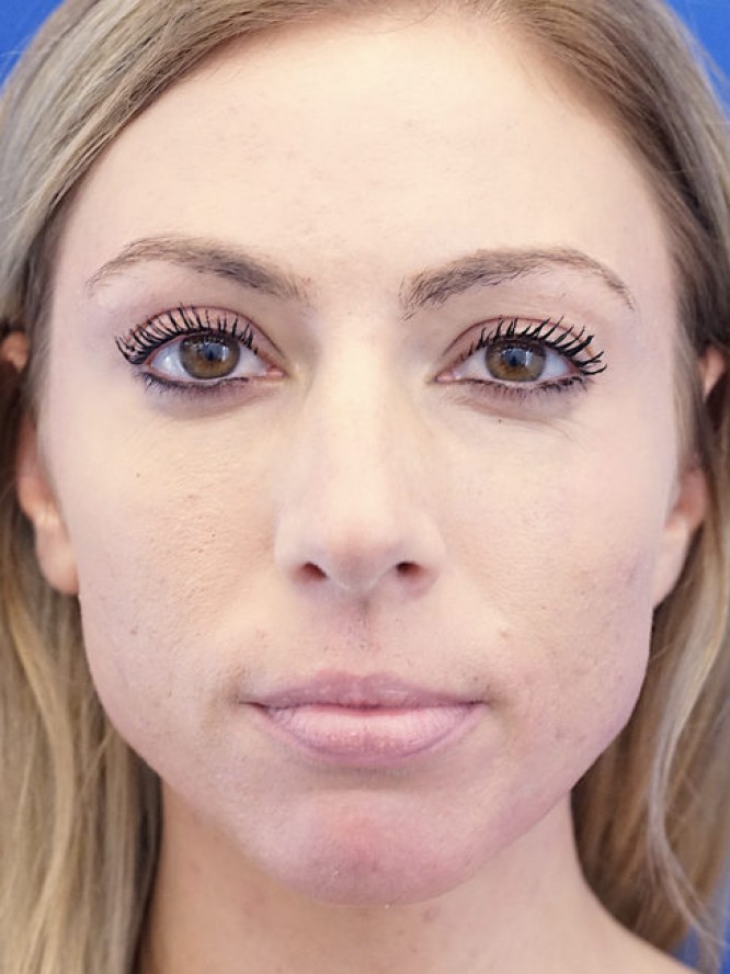 Endonasal Dainty Nose — Before