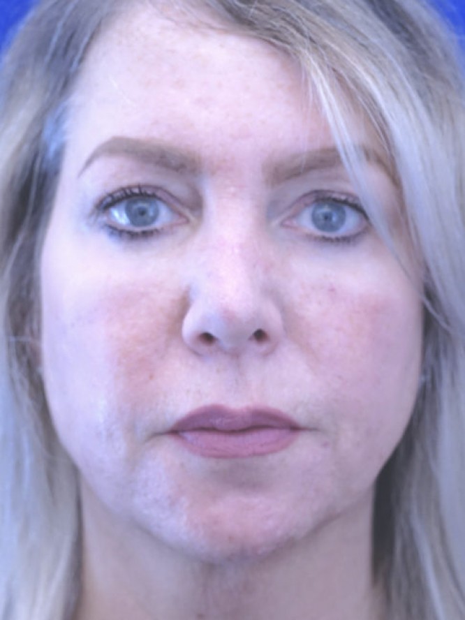 Tip Ptosis — After