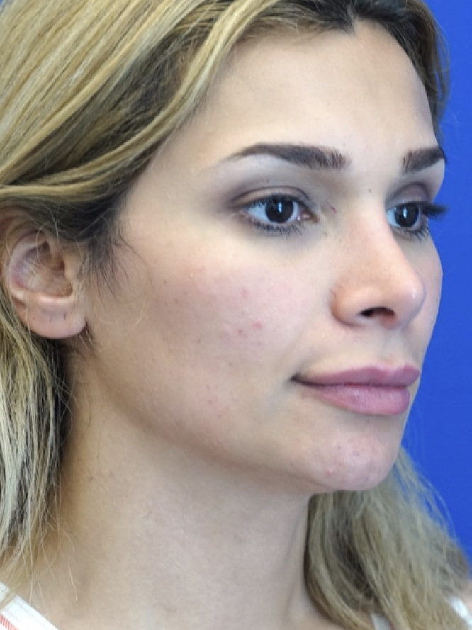 Nasal Deviation and Dainty Tip — After
