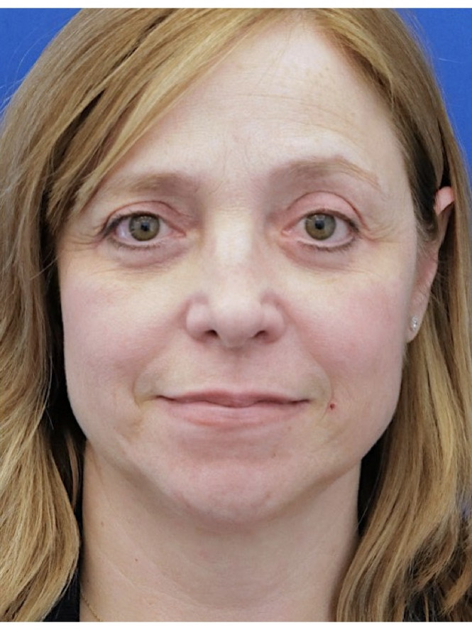 Upper and Lower Blepharoplasty — After