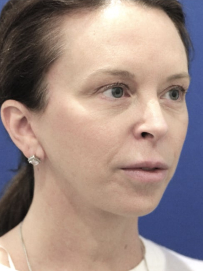 Jowling and Skin Laxity — After