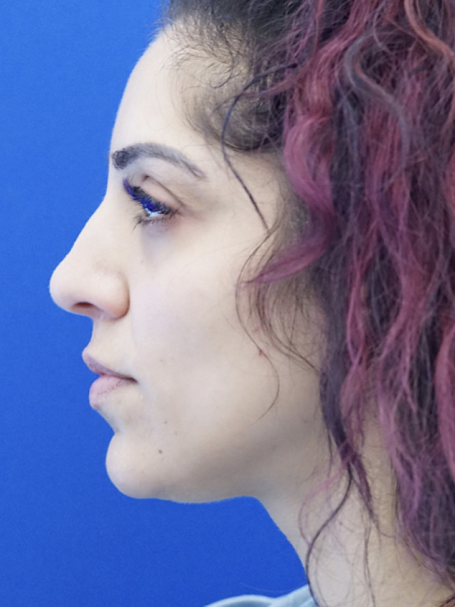 Dorsal Hump and Thick Skin — Before