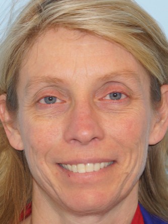 Upper Eyelid Droop1 (Ptosis)* — Before