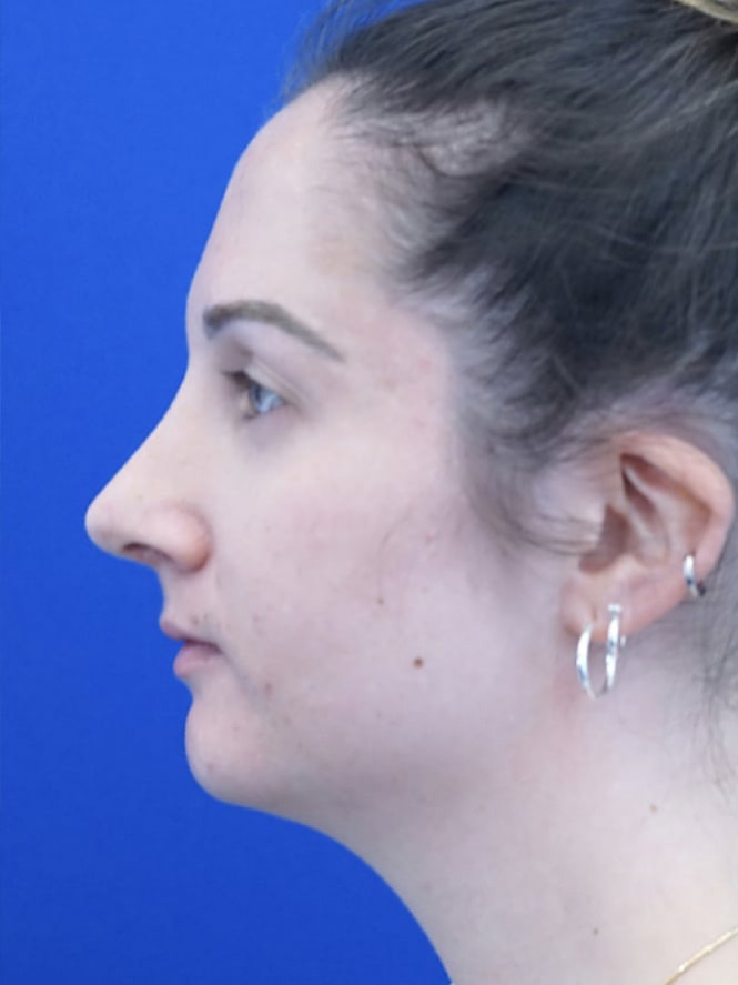 Profile Irregularity — After
