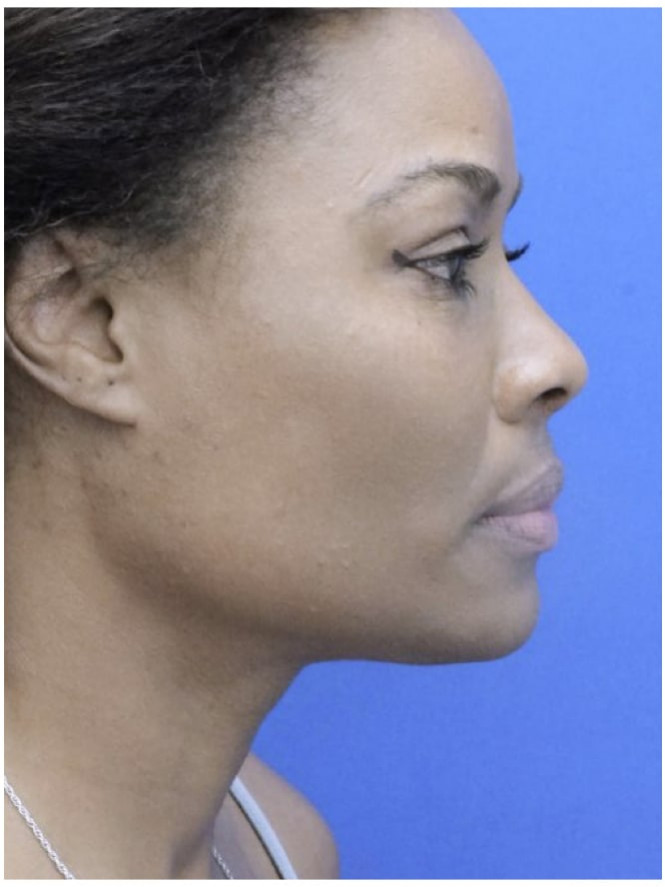 Cheek and Chin — After
