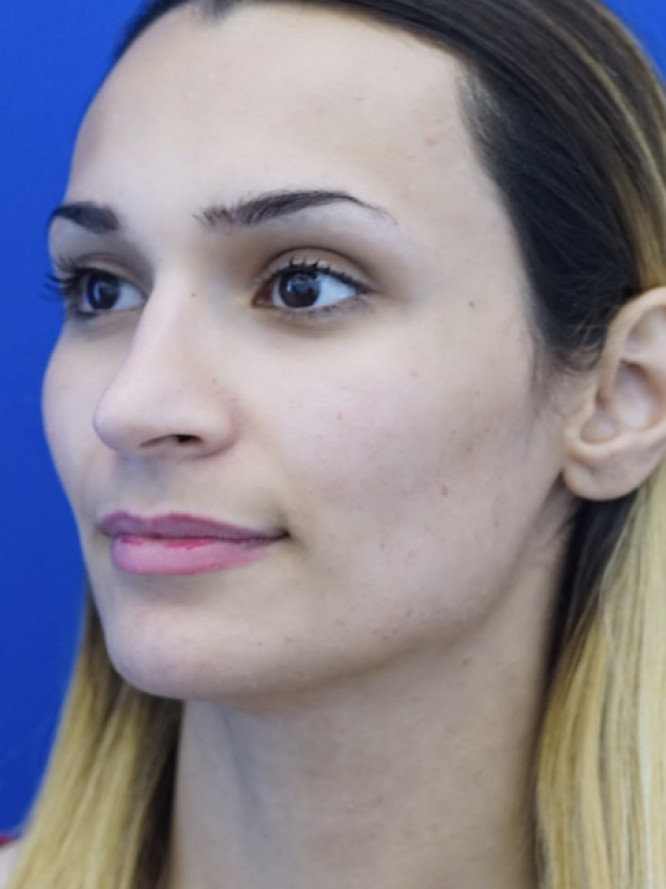 Nasal Deviation and Dainty Tip — Before