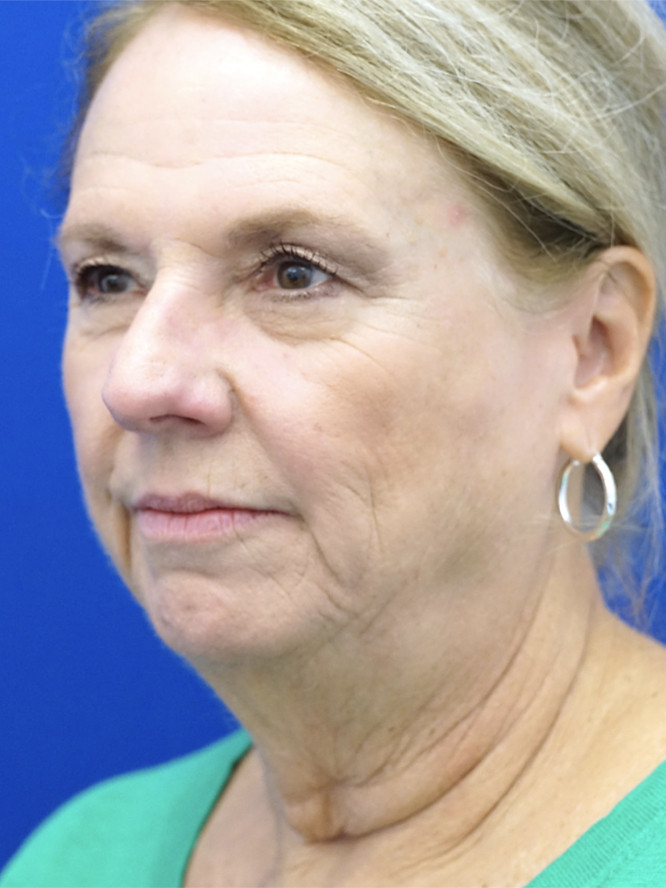 Lower Facial Aging and Fullness — Before