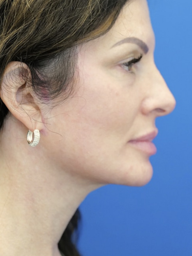 Deep Plane Cheek and Facelift — After