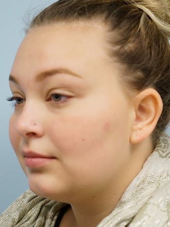 Restylane Silk Achieves Voluptuous Lips* — Before