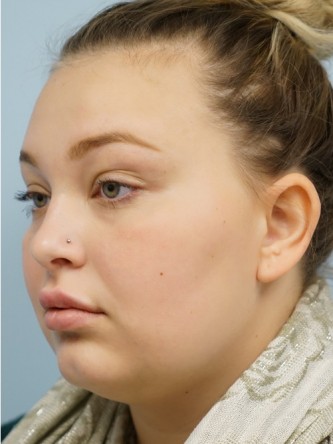 Restylane Silk Achieves Voluptuous Lips* — After
