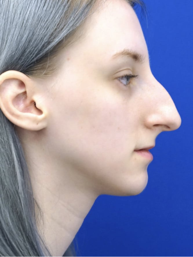 Dorsal Hump and Tension Tip — Before