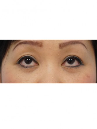 Lower Eyelid Fat Pseudoherniation* — After