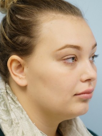 Restylane Silk Achieves Voluptuous Lips* — After