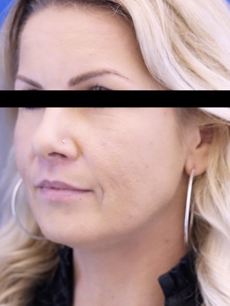 Upper Lip Shortening — After