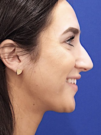Nasal Hump Closed Rhinoplasty — Before