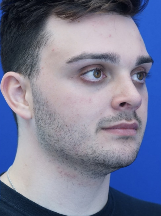 Profile Enhancement — After