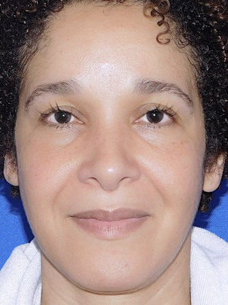 Ethnic Rhinoplasty* — After