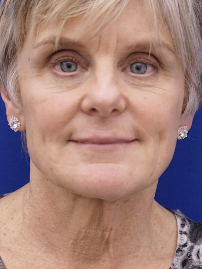 Lower Facelift Deep Plane — Before