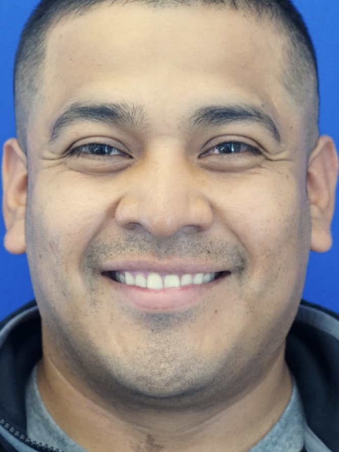 Rhinoplasty Trifecta — Before