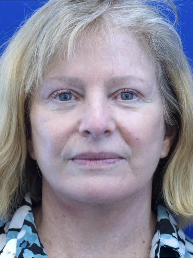 Deep Plane Jowl and Neck Lift — After